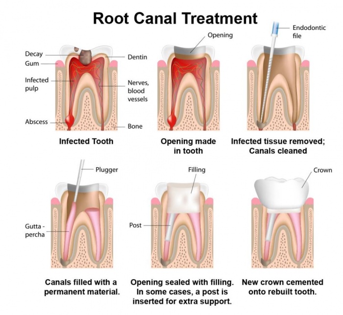root-canal-dentist-park-slope